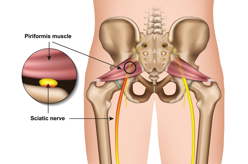 Causes and treatments of Sciatica - ( Sciatic nerve pain )